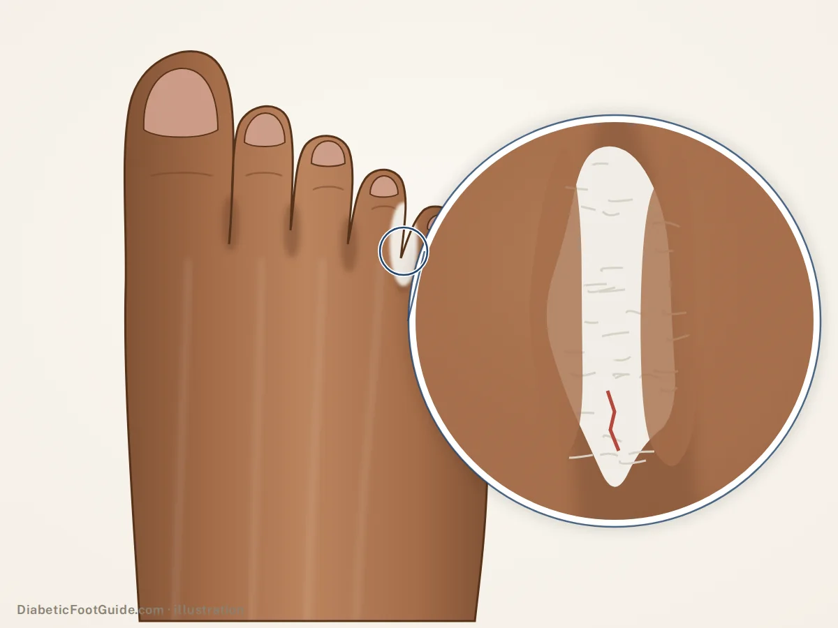 Illustration of white, soggy, peeling skin with a small split between the fourth and fifth toes on brown skin, athlete's foot, magnified