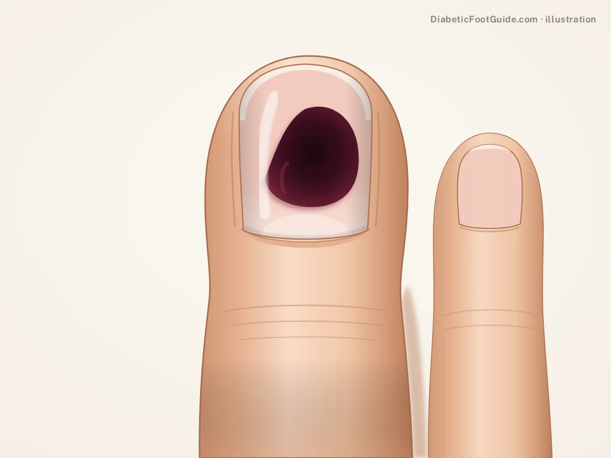 Illustration of a dark maroon-purple patch of blood under an intact big toenail, a subungual hematoma on a diabetic foot