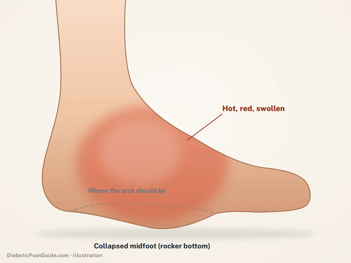 Illustration of an active Charcot foot from the inner side: a hot, red, swollen midfoot with the arch collapsed into a rocker-bottom shape