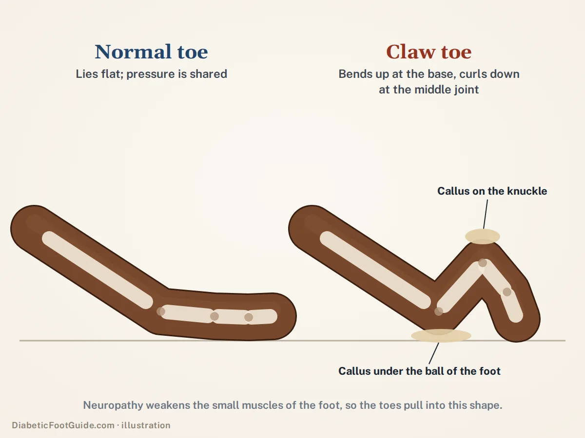 Diagram comparing a normal toe lying flat with a claw toe bent up at its base and curled down at the middle joint, with calluses on the knuckle and under the ball of the foot