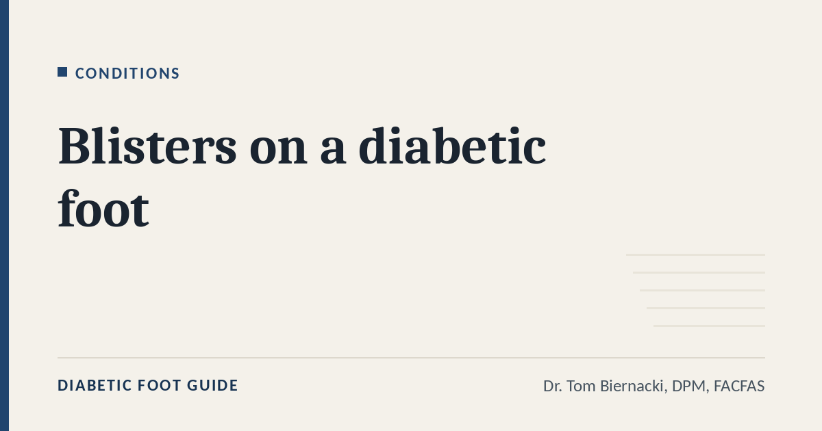 Diabetic Foot Guide article card: Blisters on a diabetic foot, in the Conditions series, by Dr. Tom Biernacki, DPM, FACFAS