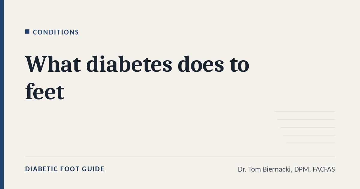 Diabetic Foot Guide article card: What diabetes does to feet, in the Conditions series, by Dr. Tom Biernacki, DPM, FACFAS