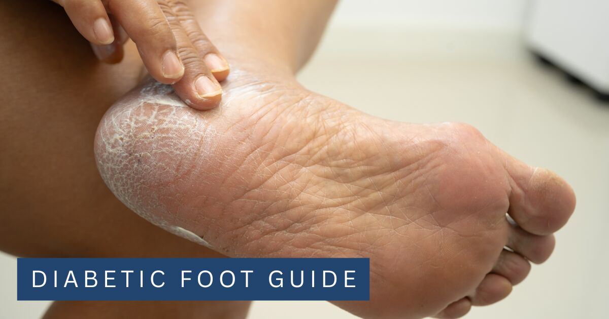 A hand applying moisturising cream to the dry flaking skin of a heel