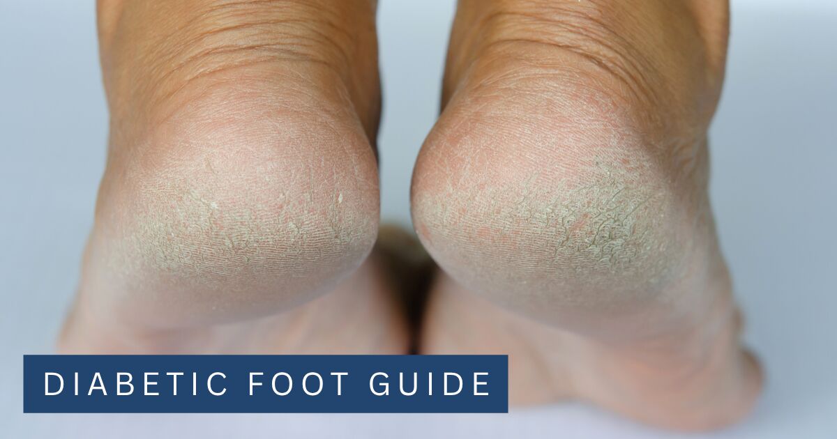 The backs of two heels showing dry thickened skin and surface cracking