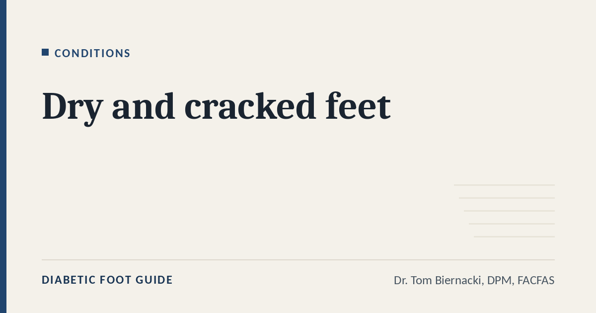 Diabetic Foot Guide article card: Dry and cracked feet, in the Conditions series, by Dr. Tom Biernacki, DPM, FACFAS