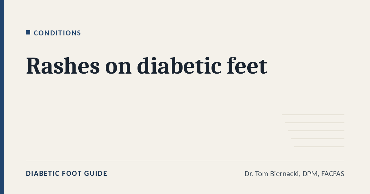 Diabetic Foot Guide article card: Rashes on diabetic feet, in the Conditions series, by Dr. Tom Biernacki, DPM, FACFAS