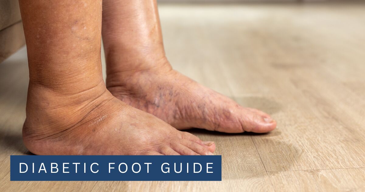 Swollen ankles and feet with visible puffiness resting on a wooden floor