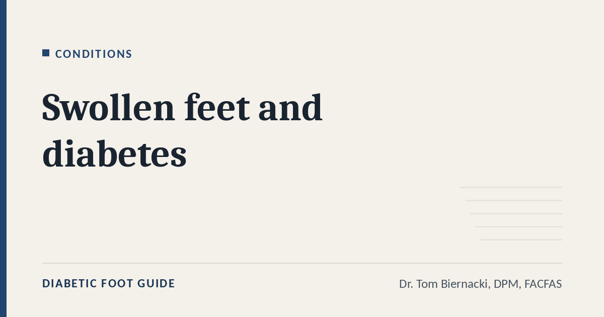 Diabetic Foot Guide article card: Swollen feet and diabetes, in the Conditions series, by Dr. Tom Biernacki, DPM, FACFAS
