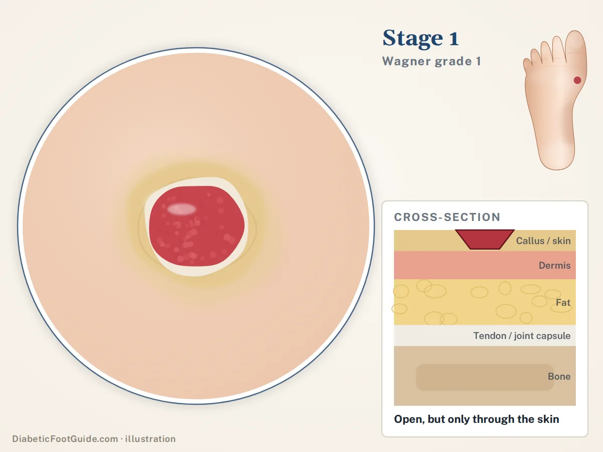 Illustration of stage 1 (Wagner grade 1): a shallow round ulcer with a red base and a white callus rim under the big toe joint, with a cross-section