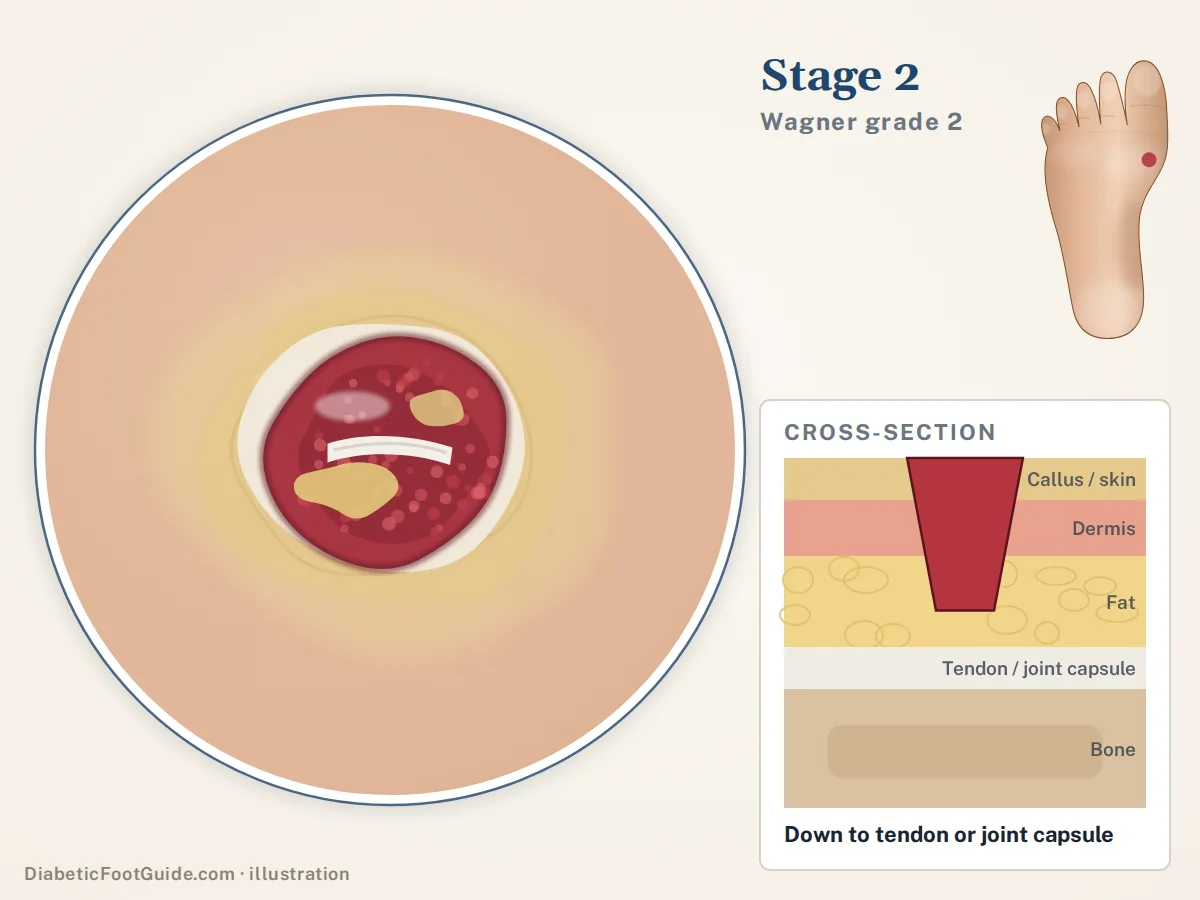 Illustration of stage 2 (Wagner grade 2): a deep crater-like ulcer with yellow slough and white tendon visible at its base, with a cross-section