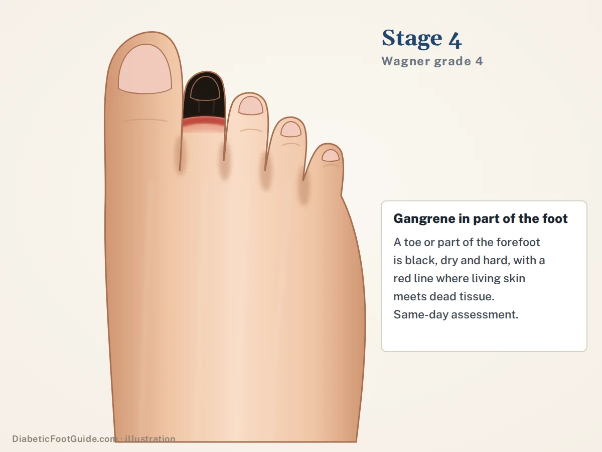 Illustration of stage 4 (Wagner grade 4): the second toe black, dry and shriveled with a red line where living skin meets dead tissue