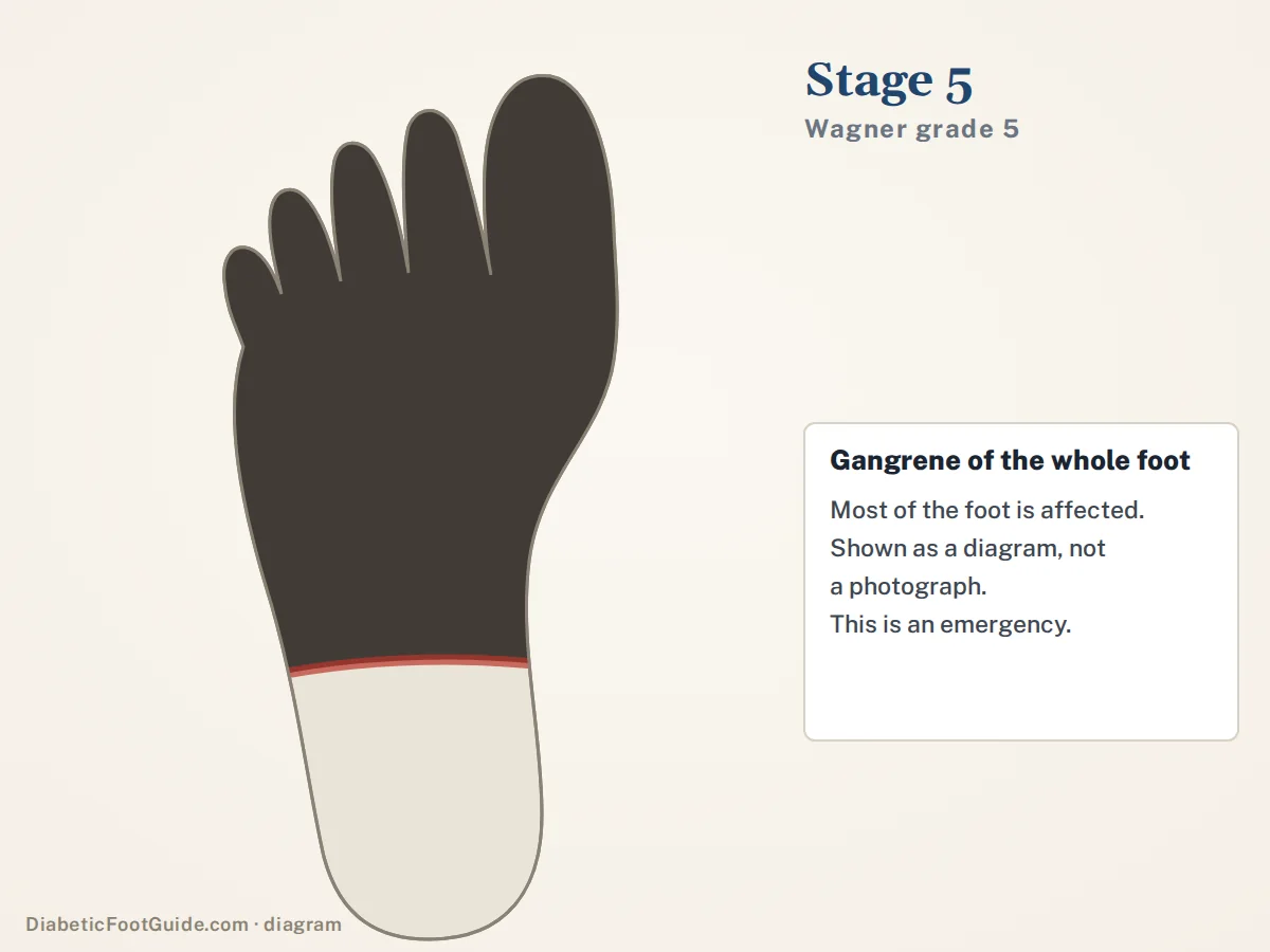 Diagram of stage 5 (Wagner grade 5): a foot outline with most of it shaded dark to represent gangrene of the whole foot