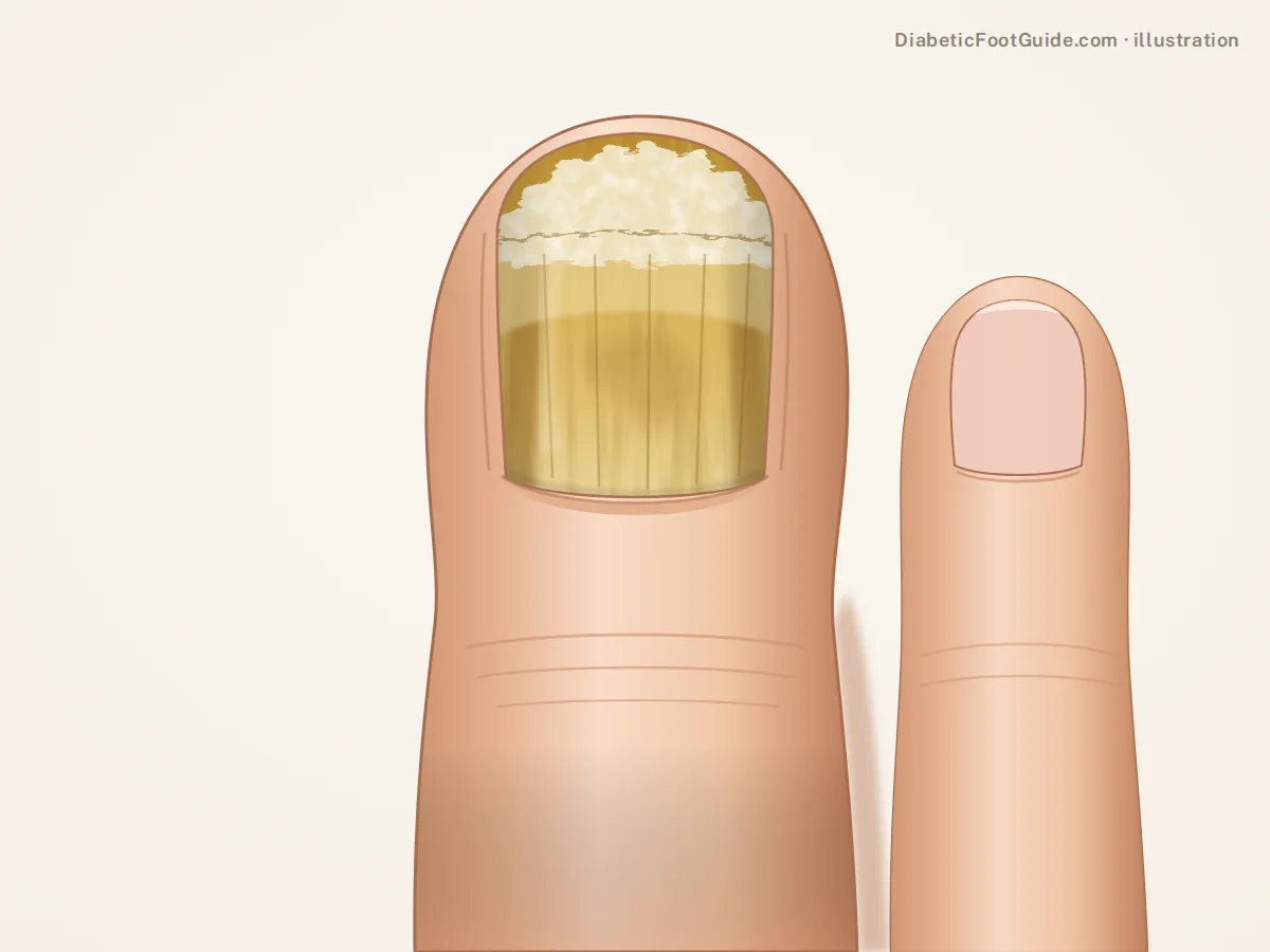 Illustration of a thick, yellow, crumbling big toenail with chalky debris under the free edge, a fungal nail on a diabetic foot