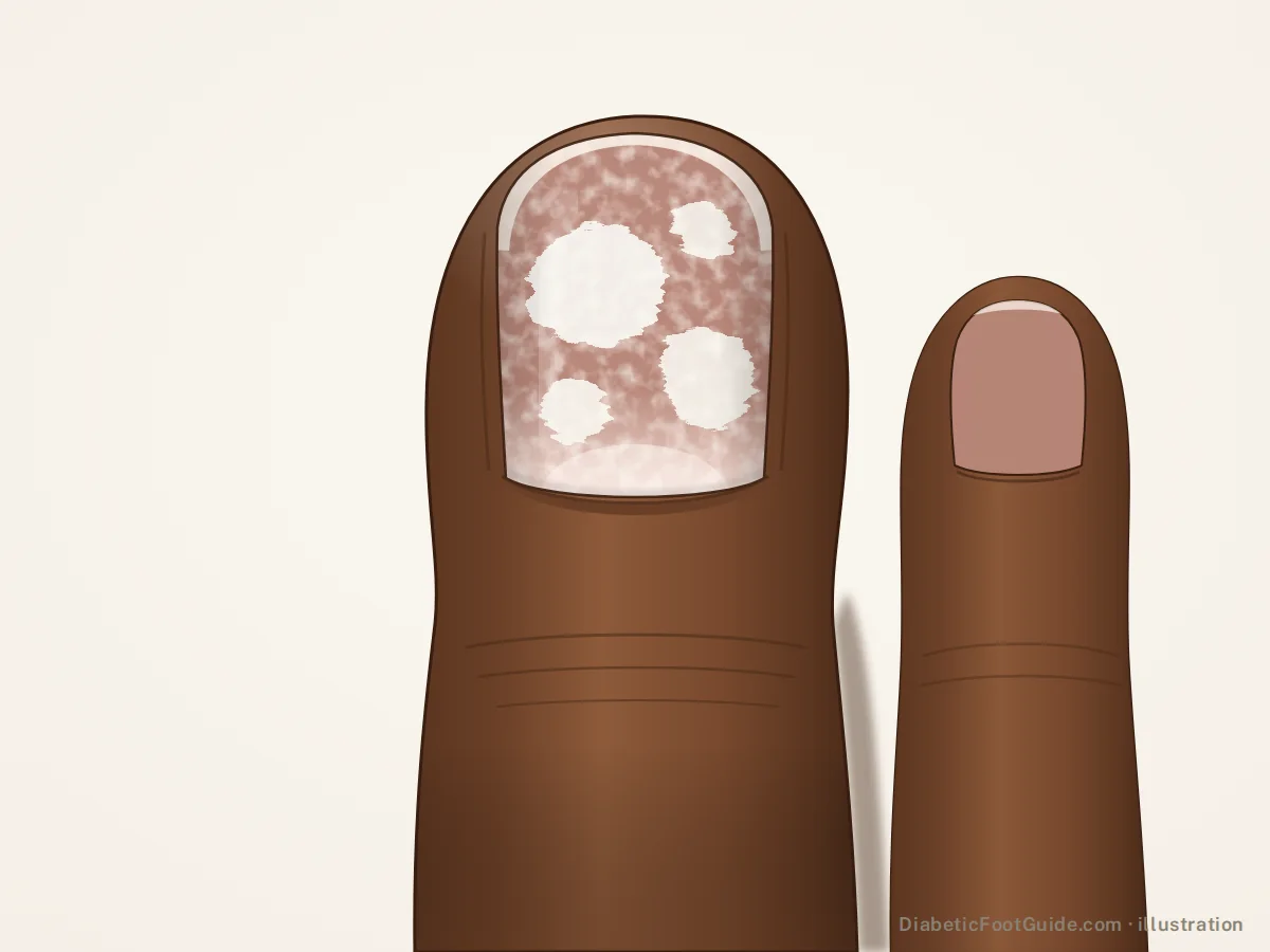 Illustration of chalky white powdery patches on the surface of a big toenail on dark brown skin, superficial white fungal infection