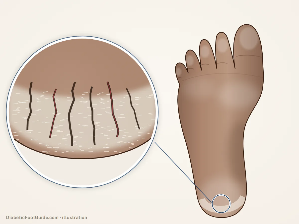Illustration of dry, ashy, thickened skin splitting into deep cracks around the rim of the heel, shown on the sole and magnified