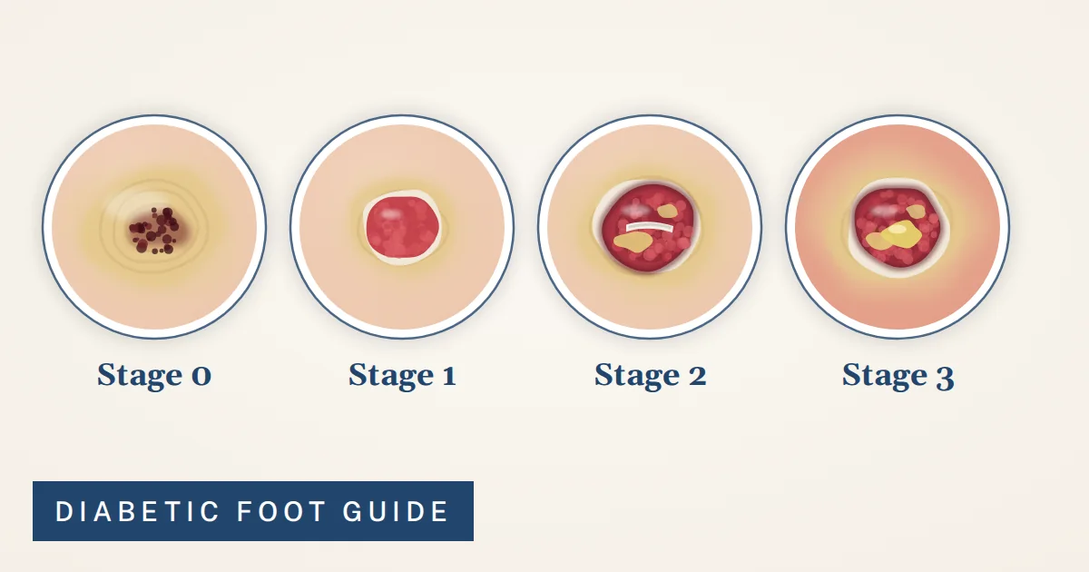 Illustration of diabetic foot ulcer stages 0 to 3 side by side