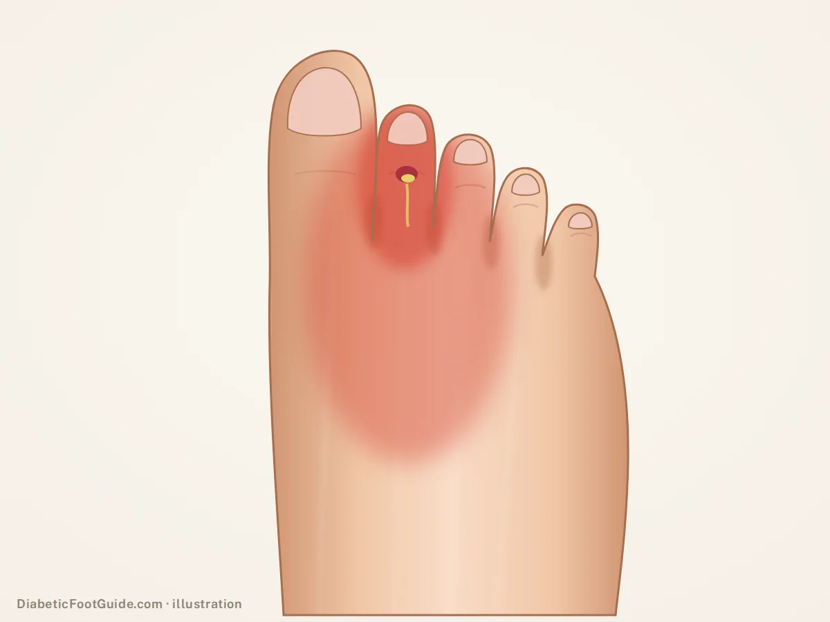Illustration of a swollen red second toe with a small draining wound on its knuckle and redness spreading onto the top of the foot