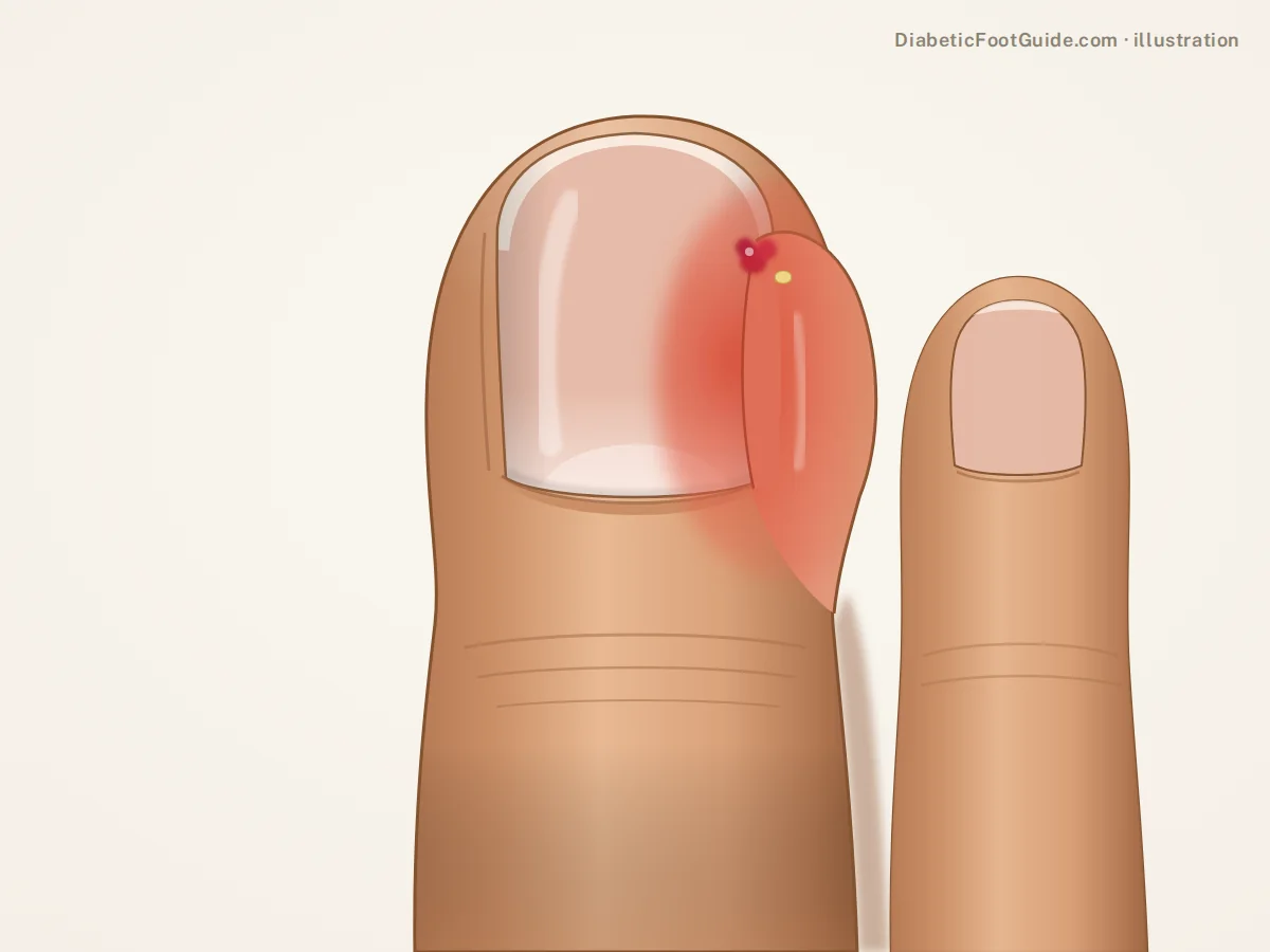 Illustration of a big toe with the side nail fold red, swollen and overlapping the nail edge, with a bead of red granulation tissue, an inflamed ingrown toenail