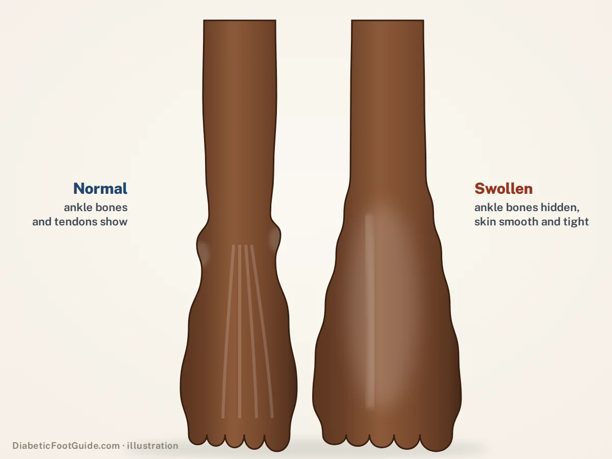 Illustration of one swollen foot and ankle with hidden ankle bones and tight skin beside a normal foot, on dark brown skin