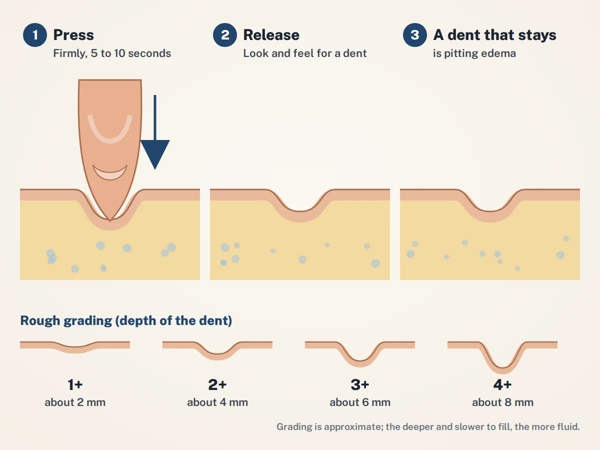 Diagram of the press test for pitting edema: press firmly for 5 to 10 seconds, release, and a dent stays; with approximate grades from 1+ (about 2 mm) to 4+ (about 8 mm)