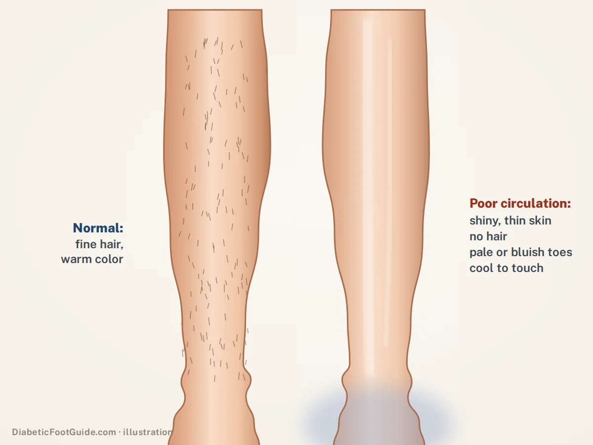 Illustration comparing a normal lower leg with fine hair to a leg with thin, shiny, hairless, pale skin and bluish toes, signs of poor circulation