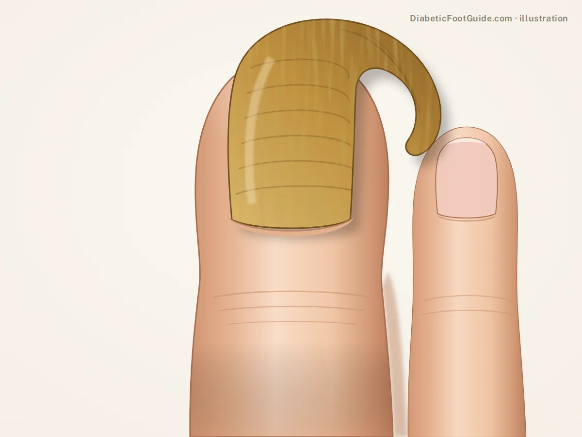 Illustration of a massively thickened, curved, overgrown big toenail curling over the second toe, onychogryphosis