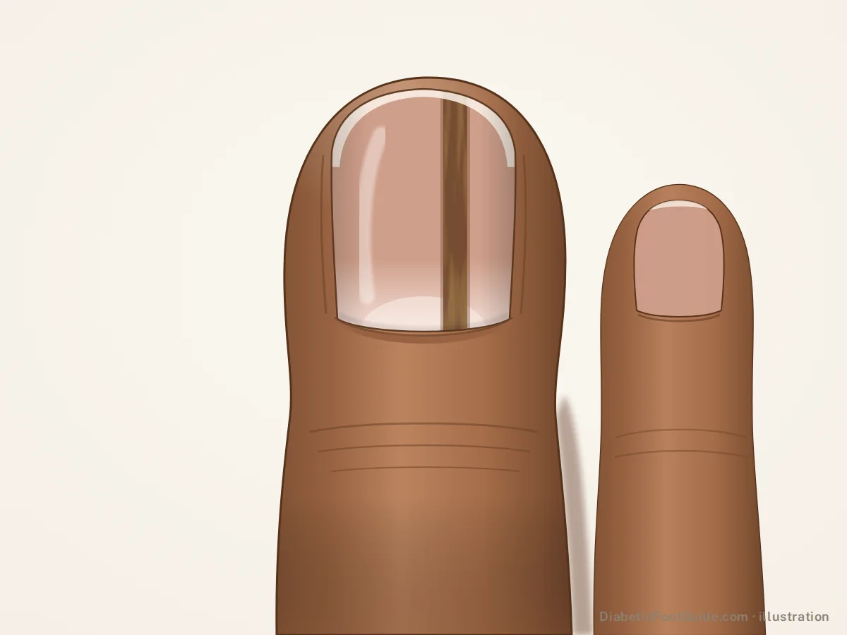 Illustration of a single even brown stripe running the length of a big toenail on medium brown skin, longitudinal melanonychia
